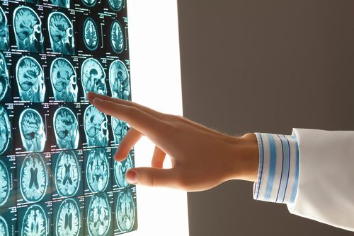 brain and spinal cord injury lawyer